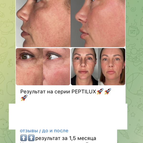 Rezultāti no peptilux krēma