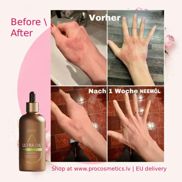 Lolum neem oil before after Chogan buy online