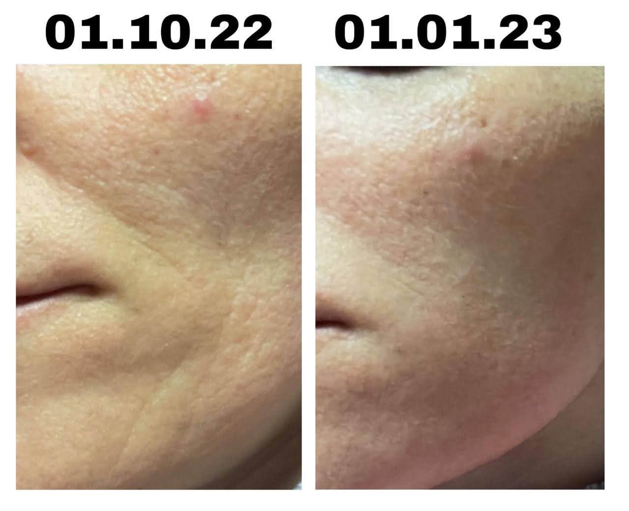 Peptilux nakts serums ar fillera efektu LUX005 30ml 4 Peptilux pirms un pec